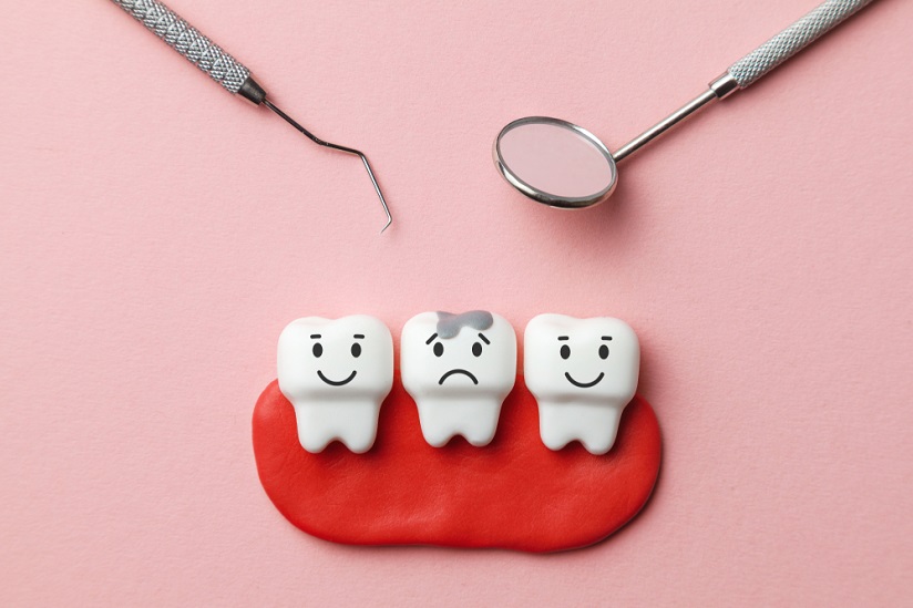 Penyebab Karies gigi dan Tips Cerdas Mencegahnya